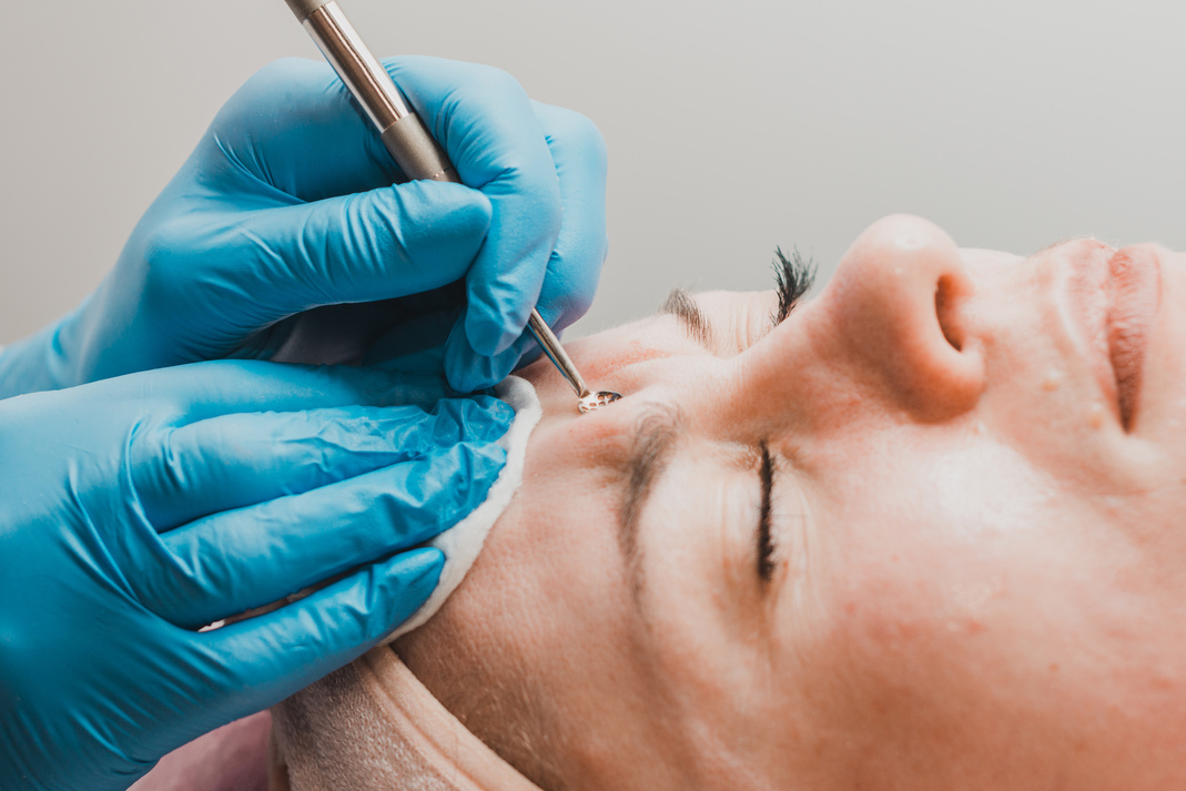 Mechanical facial cleansing, skin cleansing procedure from surface and deep impurities.